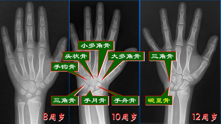 测骨龄预测身高帮助孩子实现长高之梦